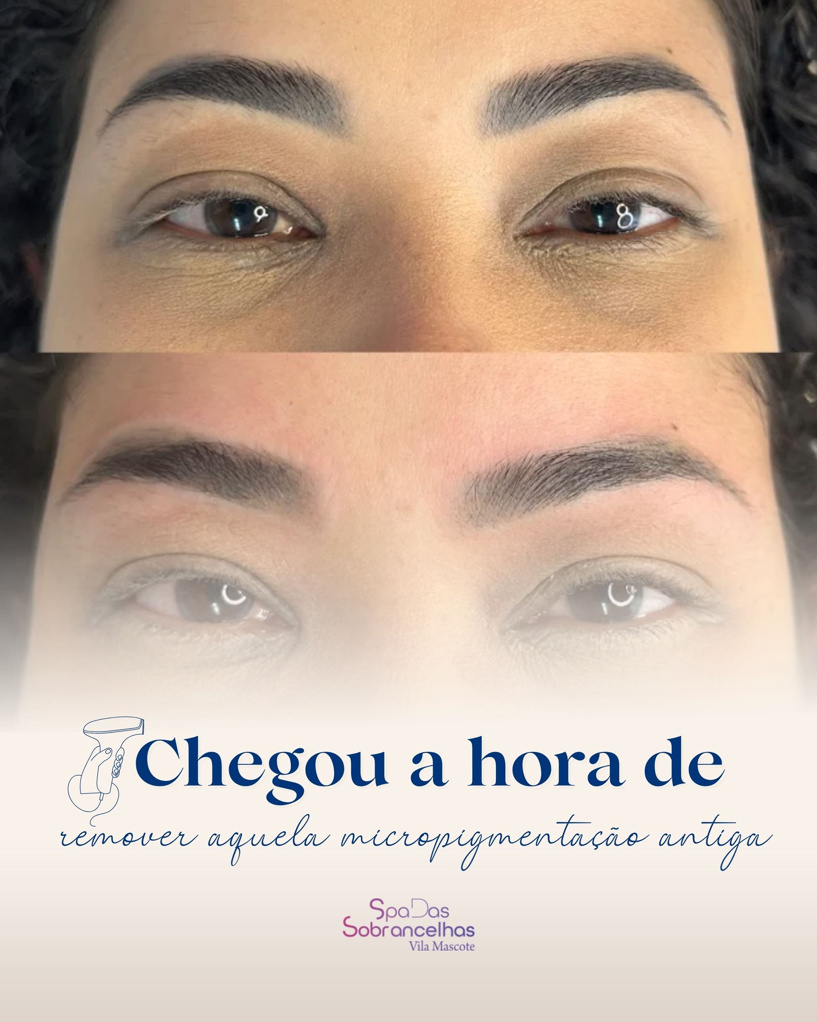 Quer corrigir ou remover uma micropigmentação antiga? Chegou a sua hora!
Conheça nosso tratamento de remoção e recupere a liberdade de escolher um novo design para suas sobrancelhas.

Agende seu horário 💜

☎️ 2305-2262 ou 99331-7580 wapp.
📍 Rua Itagyba Santiago, 603 - Vila Mascote - SP
⏰ Terça a Sexta: 9h~19h e Sábado: 9h~17h

#RemocaoDeMicropigmentacao #LaserSobrancelhas #DesignDeSobrancelhas #SpaVilaMascote #VilaMascote #JdPrudencia